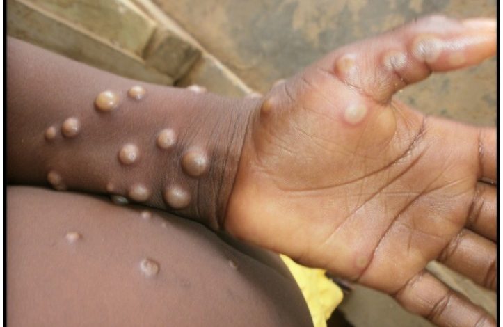 monkeypox, vaccine, Kevin Jackson